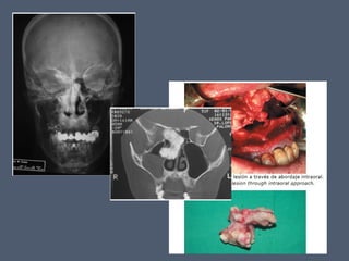 14 cavidad nasal y_senos_perinasales_2_ - 