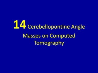 14Cerebellopontine Angle
Masses on Computed
Tomography
 