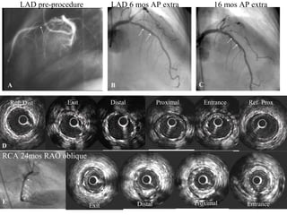 A B C
DistalExit Proximal Entrance Ref ProxRef Dist
16 mos AP extraLAD 6 mos AP extraLAD pre-procedure
D
E
RCA 24mos RAO oblique
DistalExit Proximal Entrance
 