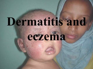 Dermatitis and
eczema
 