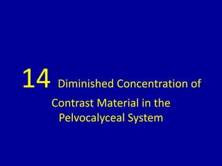 14 Diminished Concentration of
Contrast Material in the
Pelvocalyceal System
 