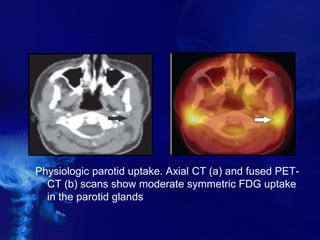Physiologic parotid uptake. Axial CT (a) and fused PET-
CT (b) scans show moderate symmetric FDG uptake
in the parotid glands
 