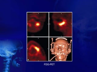 FDG-PET
 