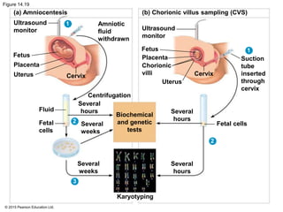 © 2015 Pearson Education Ltd.
Figure 14.19
(a) Amniocentesis (b) Chorionic villus sampling (CVS)
Ultrasound
monitor
Fetus
Placenta
Uterus Cervix
Amniotic
fluid
withdrawn
Karyotyping
Several
hours
Several
hours
Fetal cells
Cervix
Suction
tube
inserted
through
cervix
Ultrasound
monitor
Fetus
Placenta
Chorionic
villi
Uterus
Centrifugation
Several
hours
Several
weeks
Several
weeks
Biochemical
and genetic
tests
Fluid
Fetal
cells
1
2
3
2
1
 