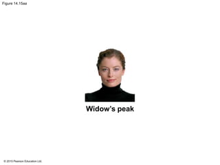 © 2015 Pearson Education Ltd.
Figure 14.15aa
Widow’s peak
 