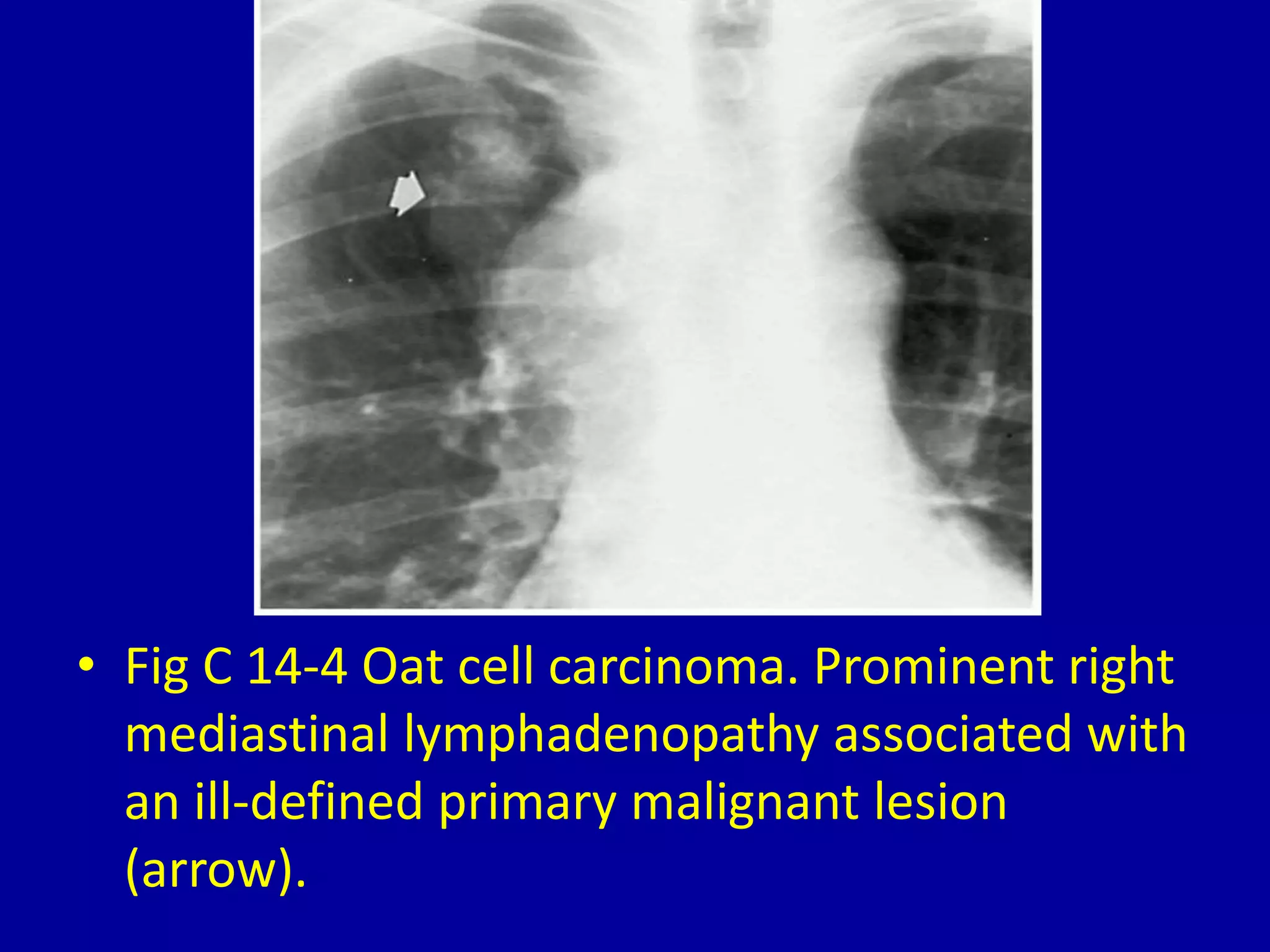 14 hilar and mediastinal lymph node enlargement | PPTX