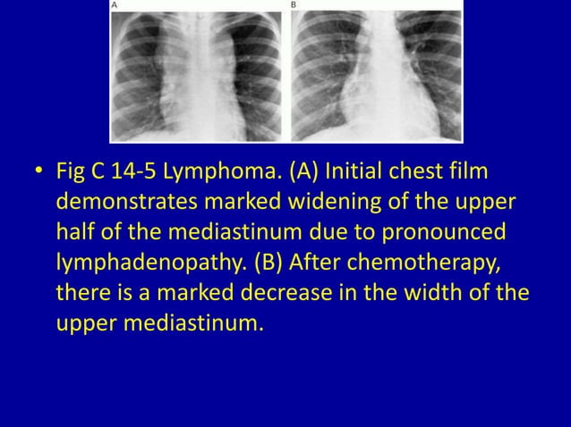 14 hilar and mediastinal lymph node enlargement | PPTX | Lung and ...