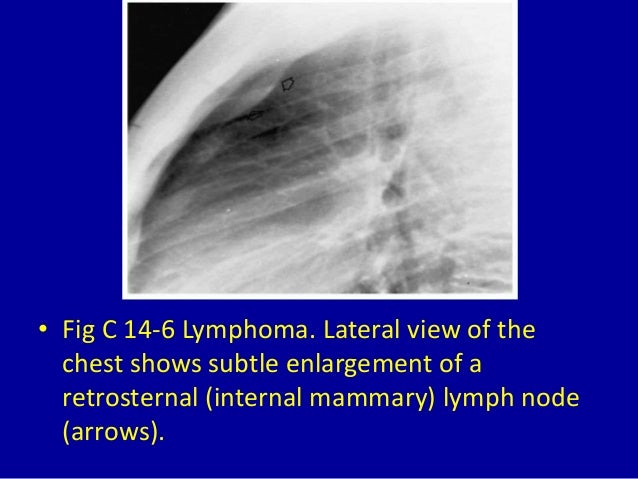 14 hilar and mediastinal lymph node enlargement