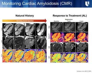 How Imaging Plays a Role in the Future Treatment of Cardiac Amyloidosis ...