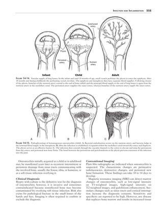 Infection and Inflammation  335
Osteomyelitis initially acquired as a child or in adulthood
may be manifested years later as recurrent intermittent or
persistent drainage from sinus tracts communicating with
the involved bone, usually the femur, tibia, or humerus, or
as a soft tissue infection overlying it.
Clinical Diagnosis
Biopsy with culture is the definitive test for the diagnosis
of osteomyelitis; however, it is invasive and sometimes
contraindicated because noninfected bone may become
contaminated by overlying soft tissue infection. Risk also
exists for pathological fracture in the small bones of the
hands and feet. Imaging is often required to confirm or
exclude the diagnosis.
Conventional Imaging
Plain film radiographs are indicated when osteomyelitis is
suspected. The characteristic changes are permeative
radiolucencies, destructive changes, and periosteal new
bone formation. These findings can take 10 to 14 days to
develop.
Magnetic resonance imaging (MRI) can detect marrow
changes of osteomyelitis, such as low-signal intensity
on T1-weighted images, high-signal intensity on
T2-weighted images, and gadolinium enhancement. Sec-
ondary changes such as sinus tracts and cortical interrup-
tion increase the diagnostic certainty. Sensitivity and
specificity are reported to be high. However, any disease
that replaces bone marrow and results in increased tissue
Figure 14-14.  Vascular supply of long bones. In the infant and until 18 months of age, small vessels perforate the physis to enter the epiphysis. After
18 months and during childhood, the perforating vessels involute. The epiphysis and metaphysis then have separate blood supplies. Following closure
of the physis, branches of the nutrient artery extend to the end of bone (adult) and the principal blood supply to the end of long bones is again from the
nutrient artery in the medullary canal. The periosteal artery supplies the outer cortex, whereas branches of the nutrient artery supply the inner cortex.
A B C
Figure 14-15.  Pathophysiology of hematogenous osteomyelitis (child). A, Bacterial embolization occurs via the nutrient artery, and bacteria lodge in
the terminal blood supply in the metaphysis. B, After the infection is established, it expands within the medullary canal toward the cortex and diaphysis.
The physis serves as an effective barrier. C, The infection then extends through the vascular channels to the cortex to elevate and strip the periosteum
from the cortex, and periosteal new bone forms. The bond between the periosteum and perichondrium at the physis prevents extension of the infection
into the joint.
 