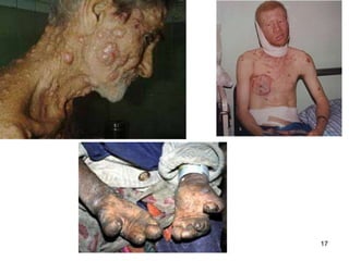 17
A SITUAÇÃO DE JÓ FERIDO FISICAMENTE:
1. 2.7 Feridas inflamadas, ulcerosas,
2. 28 coceira contínua,
3. 2.12 degeneração da pele do rosto e desfiguração,
4. 2.13 dor intensa,
5. 3.24 perda do apetite,
6. 3.25 medo e depressão,
7. 7.5 feridas purulentas que se abrem, coçam, racham e supuram,
8. vermes formados nas feridas,
9. 9.18 dificuldade para respirar,
10. 16.16 escurecimento da pálpebra,
11. 19.17 mau hálito,
12. 19.20 perda de peso,
13. 33.19 dor nos ossos,
14. 30.27 dor lancinante e contínua,
15. 30.30 febre.
Elefantíase dos Gregos (lepra negra)
JÓJÓ
 