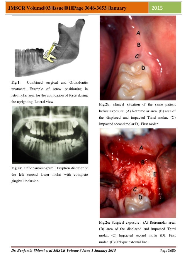 Therapy concept for Surgical Uprighting of the Impacted Second Mandib…