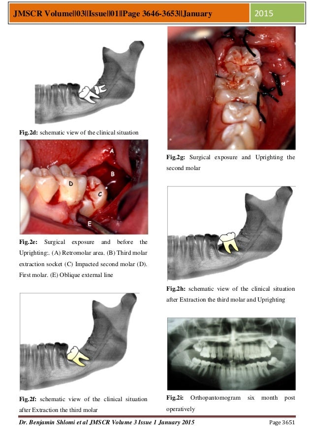 Therapy concept for Surgical Uprighting of the Impacted Second Mandib…