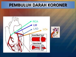 PEMBULUH DARAH KORONER
RCA
LM
LAD LCx
 