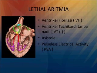 LETHAL ARITMIA
• Ventrikel Fibrilasi ( VF )
• Ventrikel Tachikardi tanpa
nadi [ VT (-) ]
• Asistole
• Pulseless Electrical Activity
( PEA )
 
