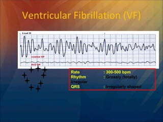 Ventricular Fibrillation (VF)
Rate : 300-500 bpm
Rhythm : Grossly (totally)
irregular
QRS : Irregularly shaped
 