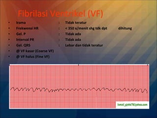 Fibrilasi Ventrikel (VF)
• Irama : Tidak teratur
• Frekwensi HR : < 350 x/menit shg tdk dpt dihitung
• Gel. P : Tidak ada
• Interval PR : Tidak ada
• Gel. QRS : Lebar dan tidak teratur
• @ VF kasar (Coarse VF)
• @ VF halus (Fine VF)
 