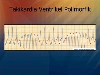 Takikardia Ventrikel Polimorfik
 