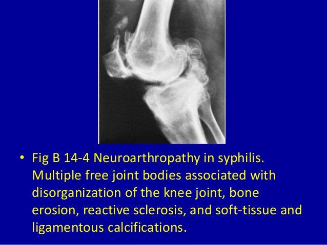 14 Loose Intra Articular Bodies