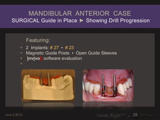 MANDIBULAR ANTERIOR CASE
   SURGICAL Guide in Place ► Showing Drill Progression


                Featuring:
            2 Implants: # 27 ▪ # 23
            Magnetic Guide Posts ▪ Open Guide Sleeves
            Invivo5 software evaluation
           




SCHA   2.2013
 