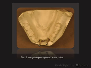 Two 3 mm guide posts placed in the holes.
 