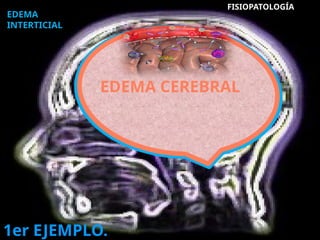 EDEMA
INTERTICIAL
1er EJEMPLO.
FISIOPATOLOGÍA
EDEMA CEREBRAL
 