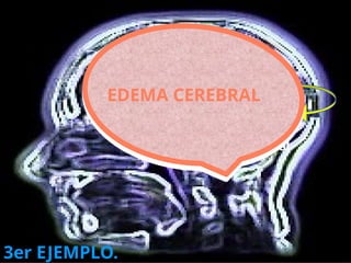 Lesión endotelial
Citoquinas P.I.
I. meníngea
P. biológicos
3er EJEMPLO.
EDEMA
VASOGENICO
EDEMA CEREBRAL
 