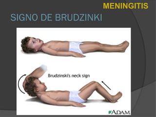 SIGNO DE BRUDZINKI
MENINGITIS
 