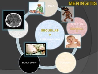 SECUELAS
Y
COMPLICACIONES
EPILEPSIA
SECUELAS
DEL
DESARROLL
O
SORDERA
HIDROCEFALIA
ABSCESO
CEREBRAL
MENINGITIS
 