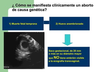¿ Cómo se manifiesta clínicamente un aborto¿ Cómo se manifiesta clínicamente un aborto
de causa genética?de causa genética?
1) Muerte fetal temprana 2) Huevo anembrionado
Saco gestacional, de 20 mm
o más en su diámetro mayor
que NONO tiene embrión visible
a la ecografía transvaginal.
 