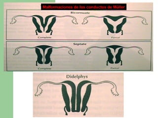 Malformaciones de los conductos de MüllerMalformaciones de los conductos de Müller
 
