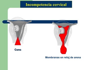 ConoCono
Membranas en reloj de arena
Incompetencia cervical
 