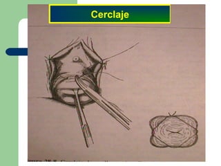 Cerclaje
 