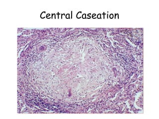 Caseation Hitopath Mycobacteria.ppt for phase 2 mbbs student | PPT