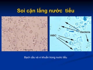Soi cặn lắng nước tiểu
Bạch cầu và vi khuẩn trong nước tiểu
 
