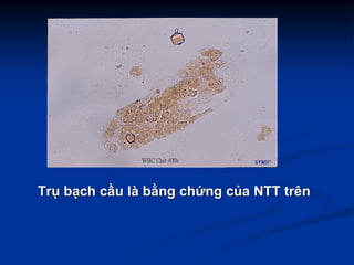 Trụ bạch cầu là bằng chứng của NTT trên
 