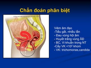 Chẩn đoán phân biệt
Viêm âm đạo
-Tiểu gắt, nhiều lần
- Đau vùng hội âm
- Huyết trắng vùng ÂĐ
- BC, Vi khuẩn trong NT
-Cấy VK <102 khúm
- VK: trichomonas,candida
 