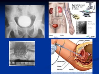 Nhiễm trùng tiểu