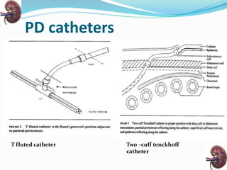 PD catheters
T fluted catheter Two –cuff tenckhoff
catheter
 