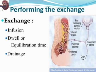 Performing the exchange
Exchange :
Infusion
Dwell or
Equilibration time
Drainage
 
