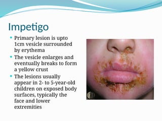 Impetigo
 Primary lesion is upto
1cm vesicle surrounded
by erythema
 The vesicle enlarges and
eventually breaks to form
a yellow crust
 The lesions usually
appear in 2- to 5-year-old
children on exposed body
surfaces, typically the
face and lower
extremities
 