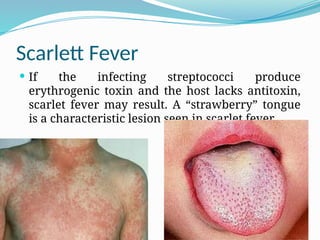 Scarlett Fever
 If the infecting streptococci produce
erythrogenic toxin and the host lacks antitoxin,
scarlet fever may result. A “strawberry” tongue
is a characteristic lesion seen in scarlet fever.
 