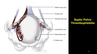 Septic Pelvic
Thrombophlebitis
17
 