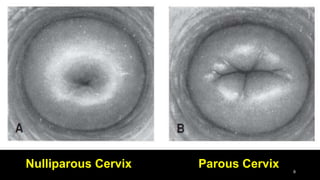 Nulliparous Cervix 8
Parous Cervix
 