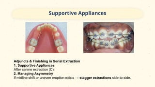 Serial Extraction- A Planned Orthodontic Approach In Paediatric ...