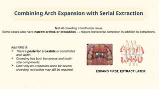 Serial Extraction- A Planned Orthodontic Approach In Paediatric ...