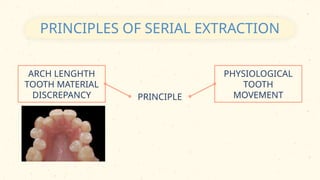 Serial Extraction- A Planned Orthodontic Approach In Paediatric ...