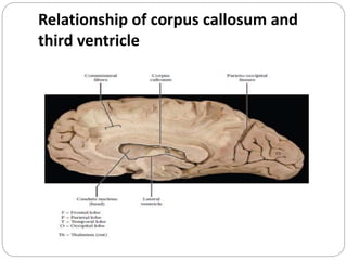 Relationship of corpus callosum and
third ventricle
 