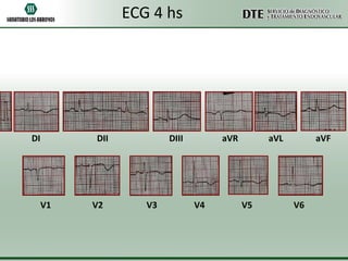 ECG 4 hs

DI

DII

V1

V2

DIII

V3

aVR

V4

aVL

V5

aVF

V6

 