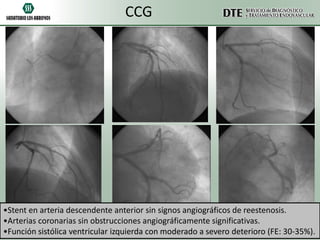 CCG

•Stent en arteria descendente anterior sin signos angiográficos de reestenosis.
•Arterias coronarias sin obstrucciones angiográficamente significativas.
•Función sistólica ventricular izquierda con moderado a severo deterioro (FE: 30-35%).

 